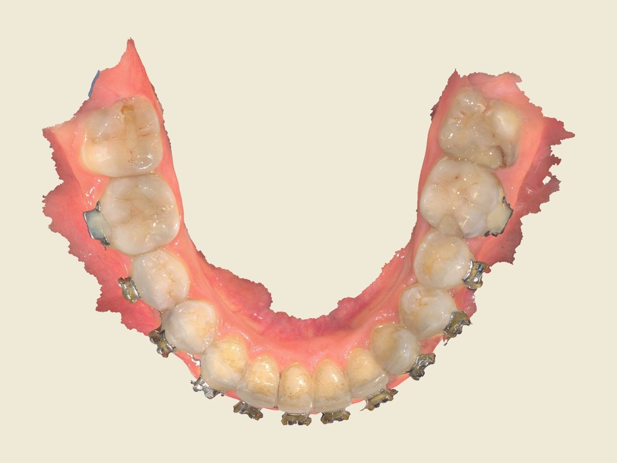 Arcada inferior