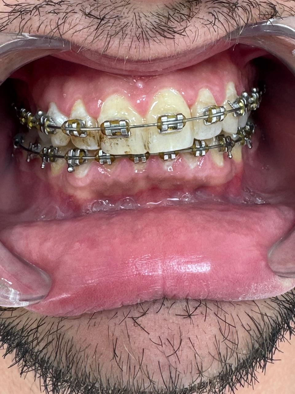 Frontal, en oclusión