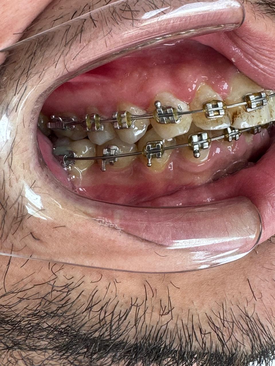 Lateral derecha