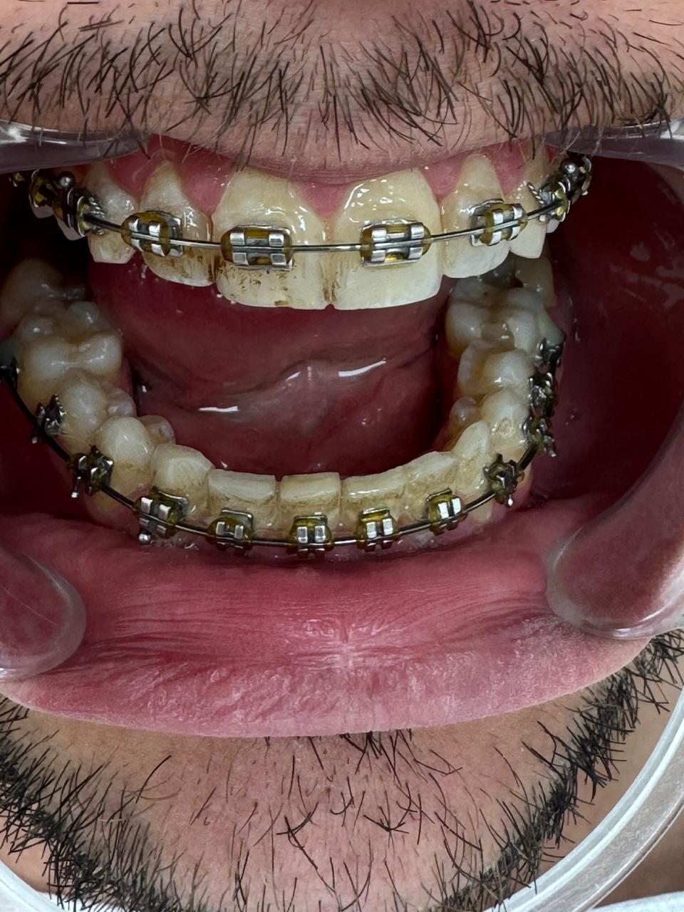 Frontal, boca abierta